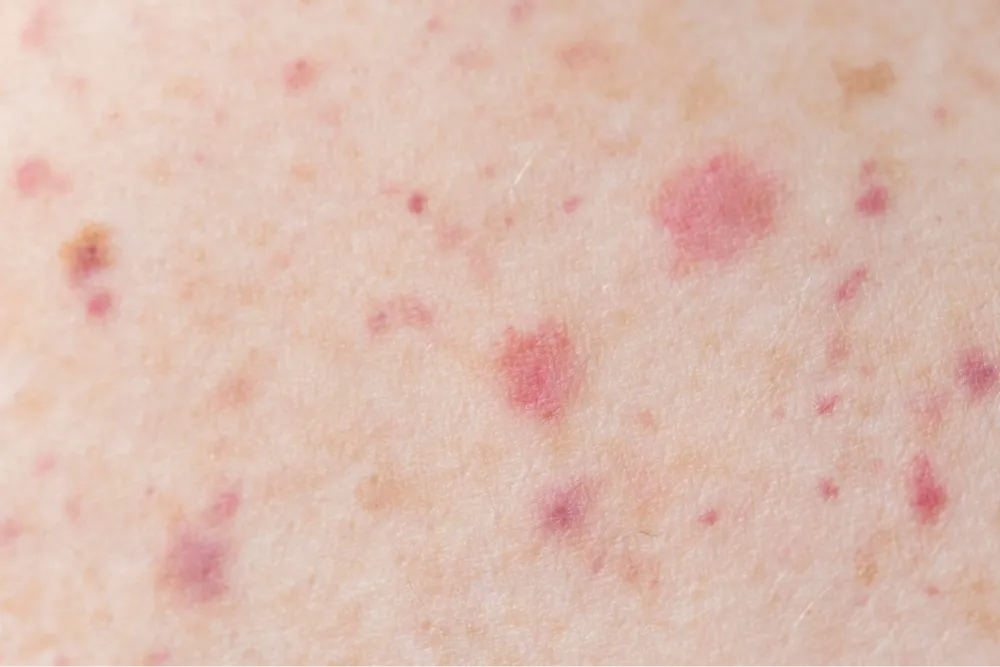 Kawasaki disease in adults